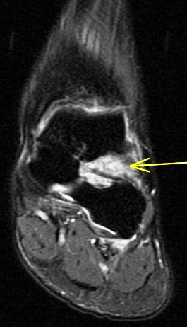 Figure 5 for case sinus tarsi  syndrome ( RID3222 )